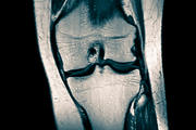 сделать МРТ коленного сустава 